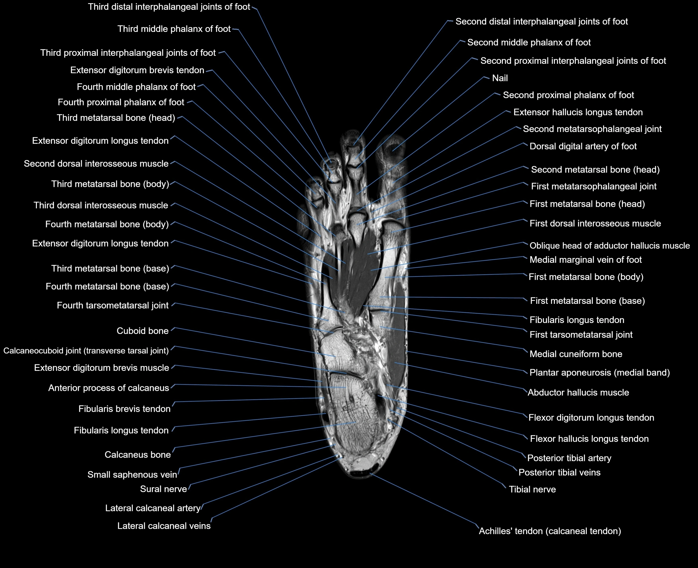 MRI foot coronal cross sectional anatomy 3T  radiology  image-img-00001-00020.webp